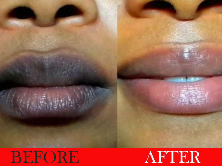 reatment of dark lip – Improvement in colour and shape of lips